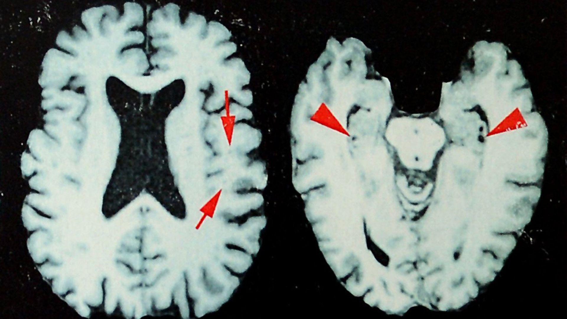 Brain Disease in Former NFL Players Reaches 98%—A Warning for Indigenous Athletic Communities