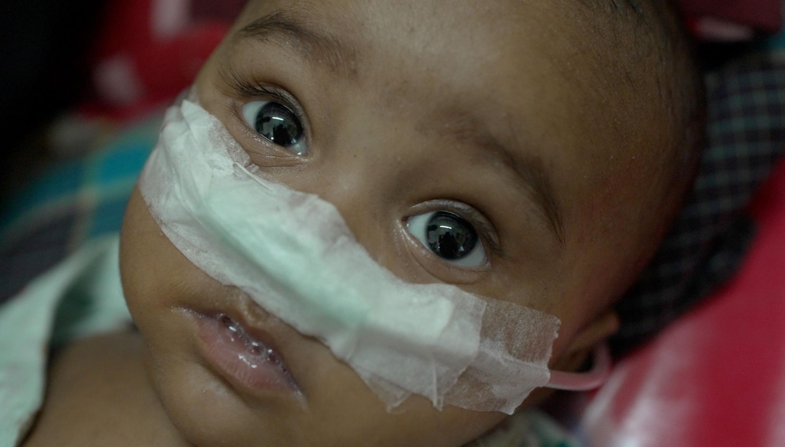 Indigenous Children Caught in Bangladesh’s Measles Surge